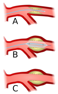 Angioplasty