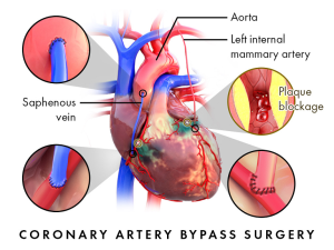 CABG surgery