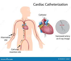 Cardiac Catherization