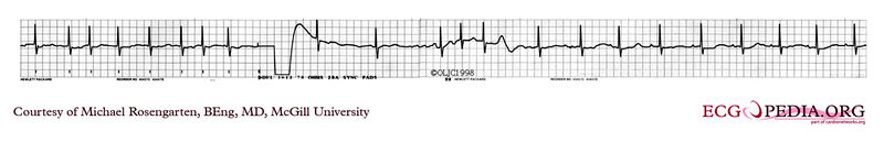 Cardioversion ECG