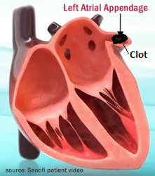 Blood clot in left atrial appendage