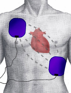 Location of defibrillation pad placement