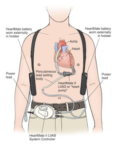 Left Ventricular Assist Device (LVAD)