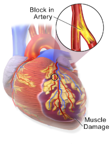 Myocardial infarction