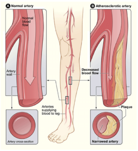 Peripheral artery disease