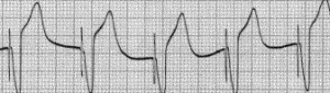 Pacemaker beats on the ECG