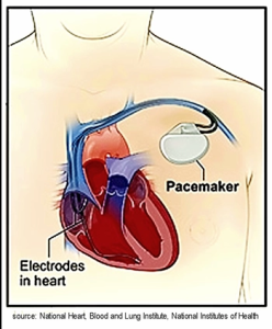 Pacemaker connected to the heart