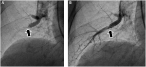 Example of stent success