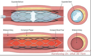 Stent Placement