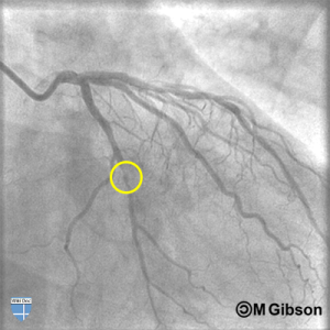 Angiogram. Yellow circle around occlusion