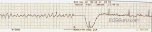 example of Vfib defibrillation back to sinus rhythm