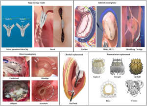 Heart valve repair