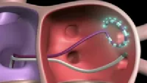 Catheter ablation