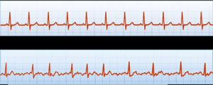 Top rhythm is normal, bottom rhythm is atrial fibrillation