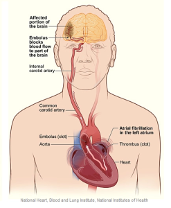 Example of a blood clot from atrial fib migrating to the brain