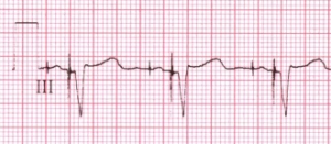 AV sequential pacemaker