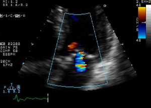 Mitral regurgitation