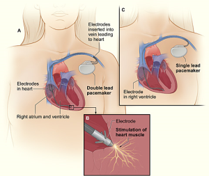 Pacemaker