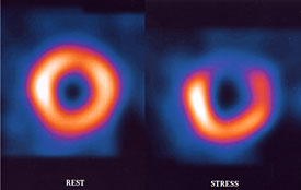 Stress induced ischemia on thallium test