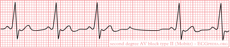 second degree av block type II