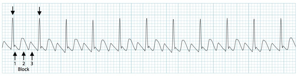 Atrial Flutter