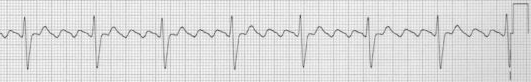 Atrial flutter