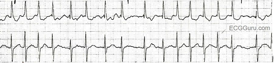 Afib rapid response