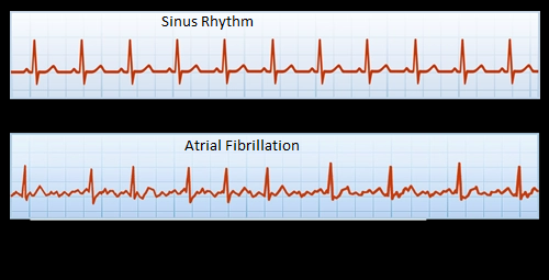 Afib on the ECG