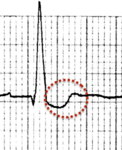 Digoxin ECG