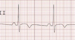 T wave inversion