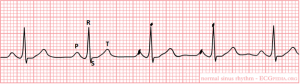 Normal sinus rhythm