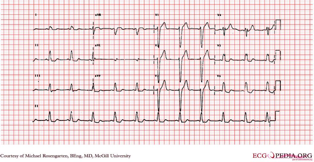 LBBB