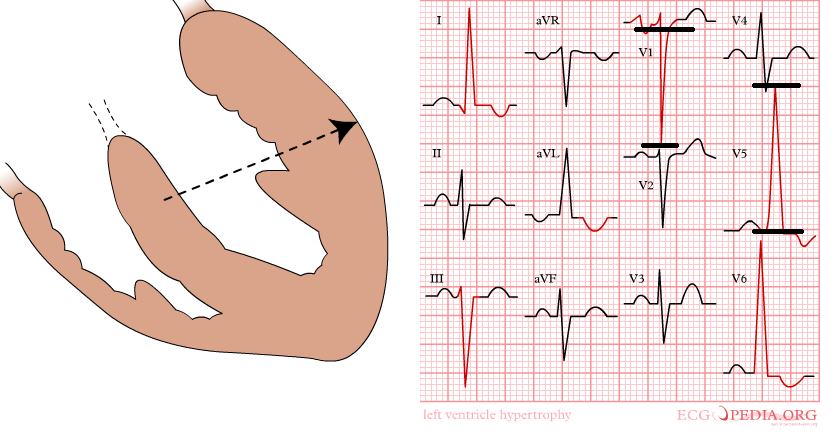 Left Ventricular Hypertrophy