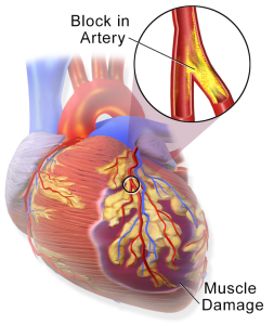 Myocardial infarction