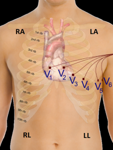 Mason Likar electrode configuration