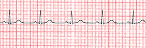 Normal T waves