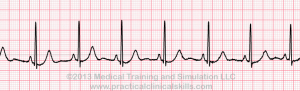 normal PR interval