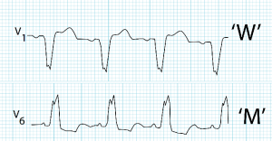 Left bundle branch block notching