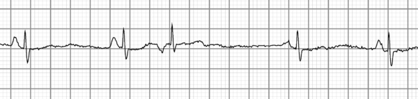 Premature junctional contraction