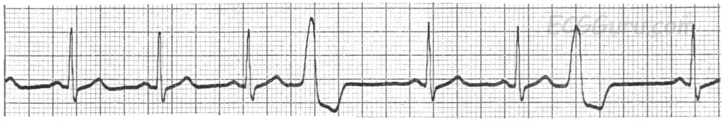 sinus rhythm with PVCs