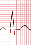 QRS width