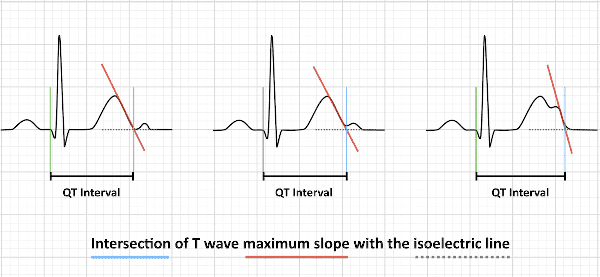 QT interval