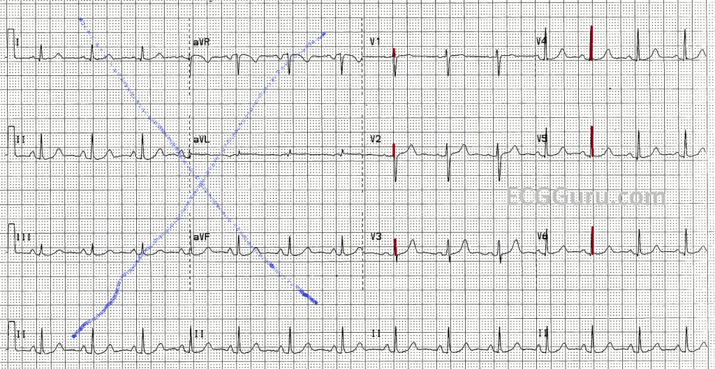 R wave progression