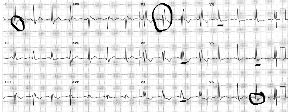 Right Bundle Branch Block