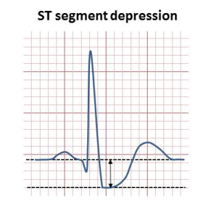 ST depression