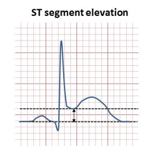 ST segment elevation