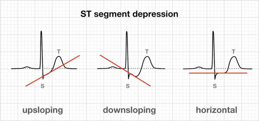 ST segment depression