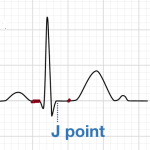 normal j point ST segment