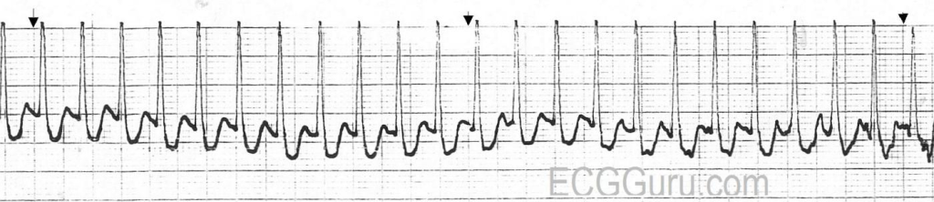 Supraventricular Tachycardia