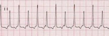 Supraventricular Arrhythmias – Cardiac Rehabilitation for the Clinical ...